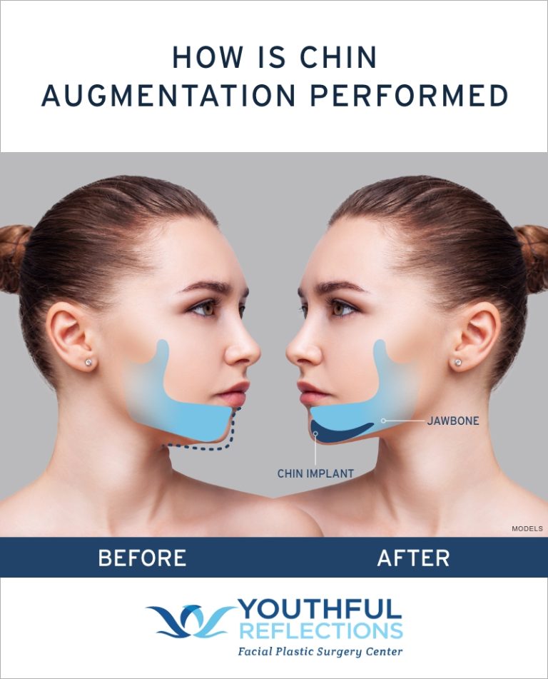 Does a Chin Implant Improve the Jawline? – Youthful Reflections